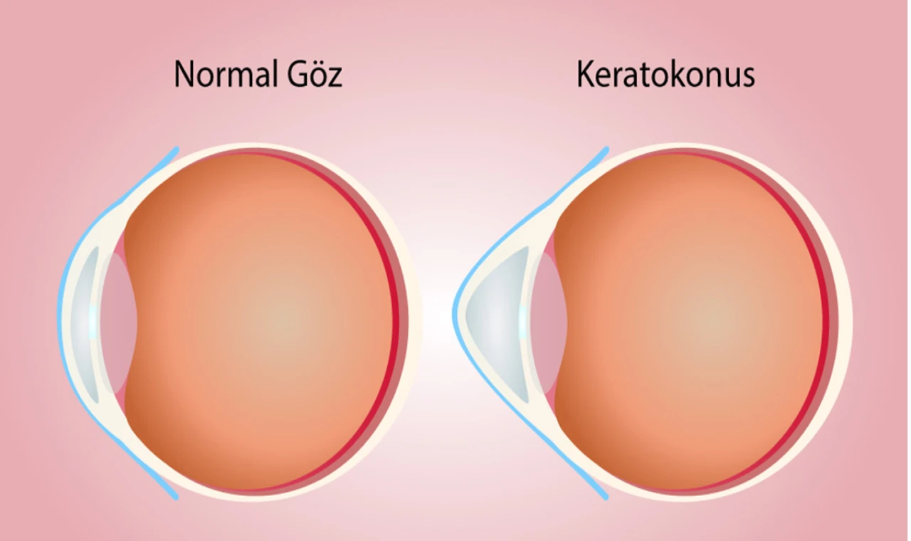 Keratokonus Nedir? Keratokonus Tedavisi Nasıl Yapılır?