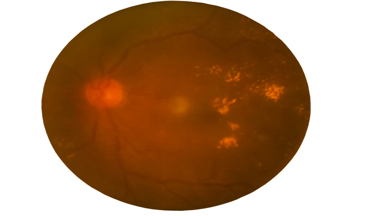 Kolesterol İlacı Diyabet Hastalarında Retina Hastalığını Yavaşlatmaktadır