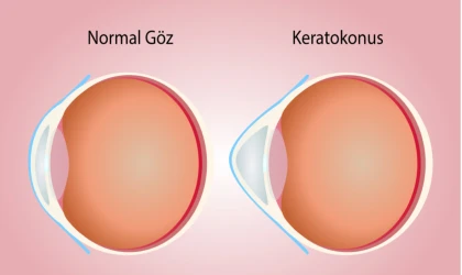 Keratokonus Nedir? Keratokonus Tedavisi Nasıl Yapılır?