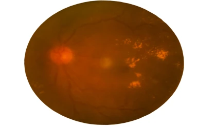 Kolesterol İlacı Diyabet Hastalarında Retina Hastalığını Yavaşlatmaktadır