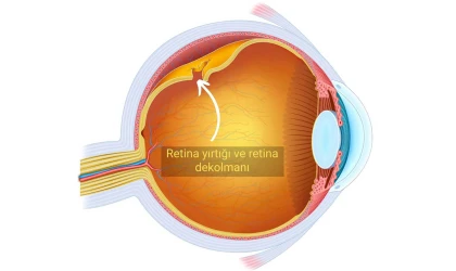 Retina Yırtığı Ve Retina Dekolmanı