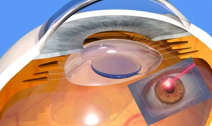 Kalıcı Lens Ameliyatı Sonrasında Lazer Yapılabilir Mi?