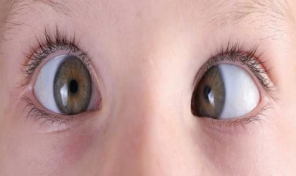 İnfantil Ezotropya Nedir?