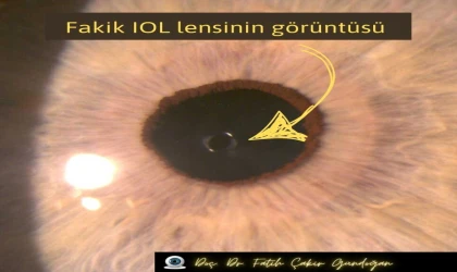 Fakik IOL Nedir?